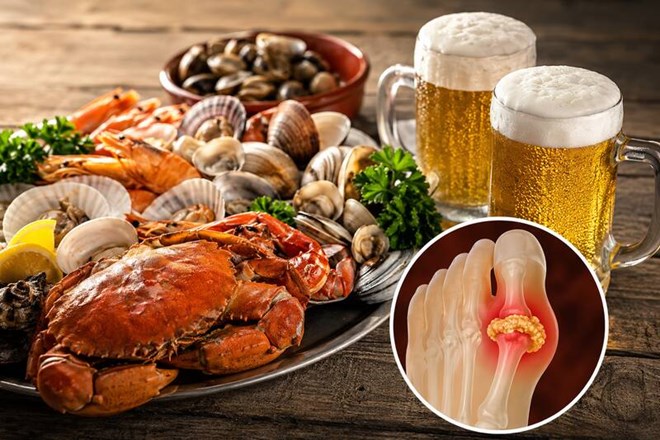 Lí do ăn hải sản uống bia dễ tăng axit uric, kích hoạt cơn gút